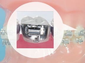 Ricci Orthodontics Bands