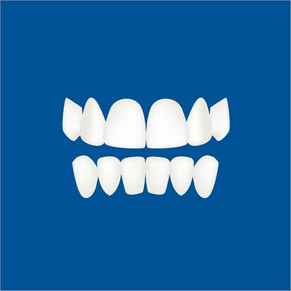 Level 2 of Treatment For Clear Aligners